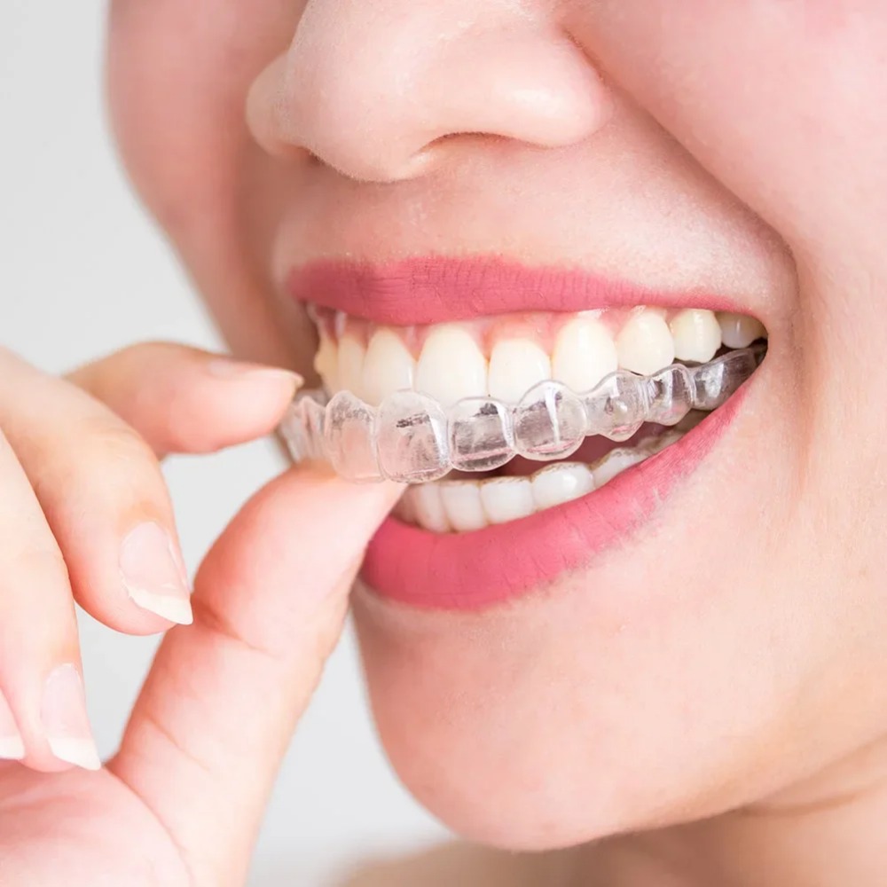Dental Guard Night - 1-4 ชิ้น อุปกรณ์ป้องกันการกรนและบดฟันขณะนอนหลับ แผ่นป้องกันฟันสำหรับการนอนหลับ อุปกรณ์ช่วยลดการบดฟัน แผ่นป้องกันเหงือก