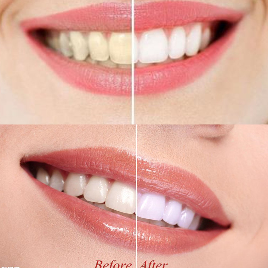 ถ่านไม้ไผ่ฟันฟันทันตกรรมสูตร L - Teeth Whitening Kit บทวิจารณ์และราคา