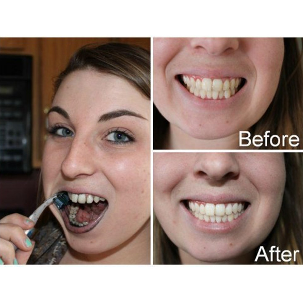 ถ่านไม้ไผ่ฟันฟันทันตกรรมสูตร L - Teeth Whitening Kit บทวิจารณ์และราคา