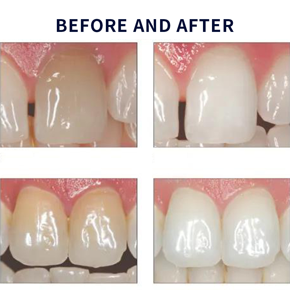20% pF 20 16ชุดเจล8x1.2มล. ชุด - Teeth Whitening With Peroxide บทวิจารณ์และราคา