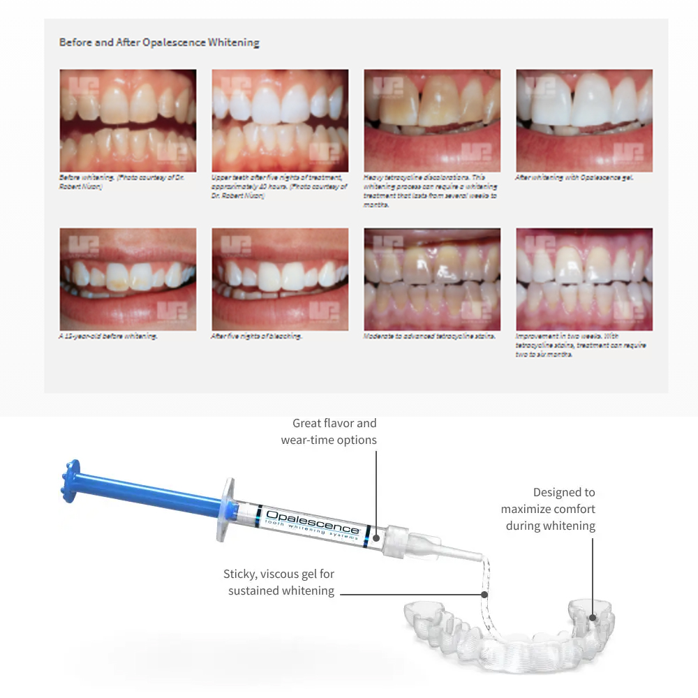 20% pF 20 16ชุดเจล8x1.2มล. ชุด - Teeth Whitening With Peroxide บทวิจารณ์และราคา