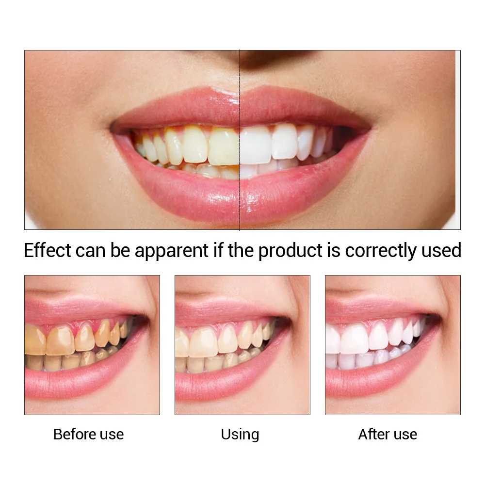 FTEENPLY ฟันไวท์เทนนิ่ง Oral ส - Teeth Whitening Ulta บทวิจารณ์และราคา