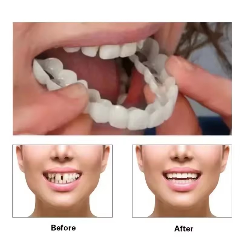 วีเนียร์ฟัน ฟอกสีฟัน ฟันปลอม ท - Teeth Whitening Kit บทวิจารณ์และราคา