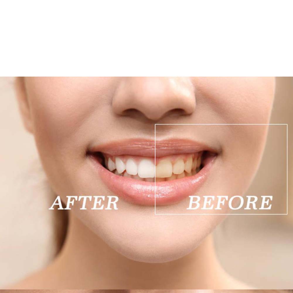 ชุดเจลฟอกสีฟอกสีฟันเปอร์ออกไซด - Teeth Whitening With Peroxide บทวิจารณ์และราคา