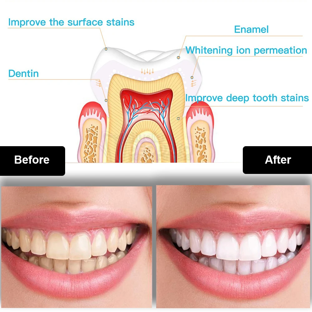 ทันตกรรมชุดฟอกสีฟัน Mini 16 LE - Teeth Whitening Gel Pen บทวิจารณ์และราคา